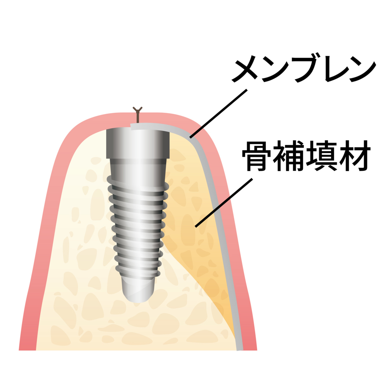 吉祥寺のインプラント治療