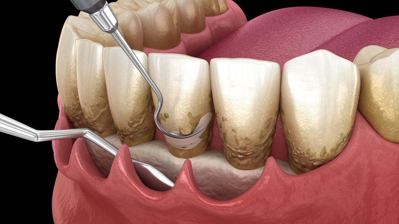 吉祥寺の歯周病の治療