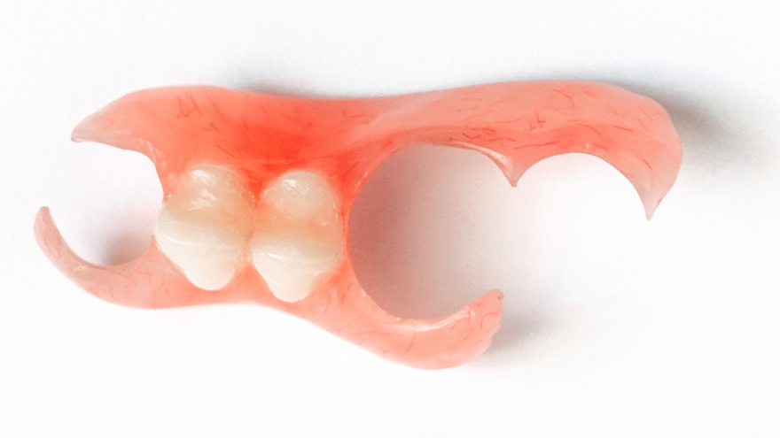 吉祥寺のノンクラスプデンチャー治療