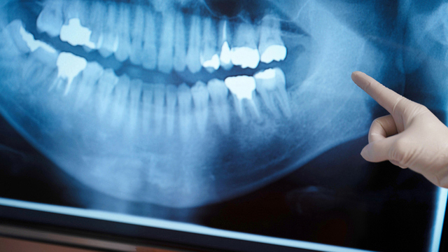 吉祥寺の歯周病の治療