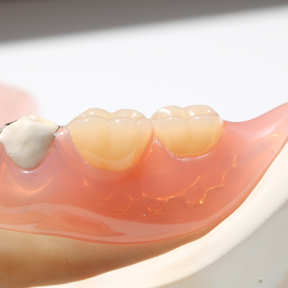 吉祥寺のノンクラスプデンチャー治療