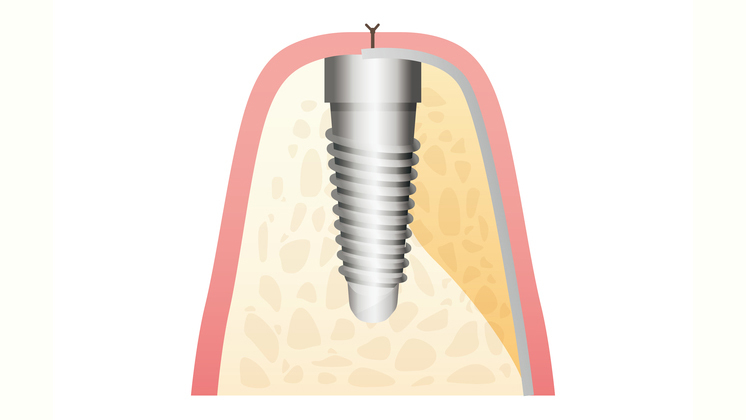 吉祥寺のインプラント治療