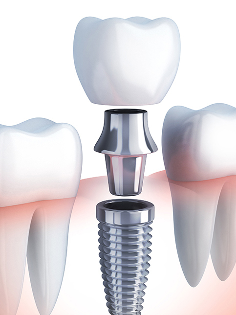 吉祥寺のインプラント治療