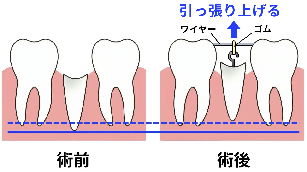 吉祥寺のエクストルージョン（歯根挺出術）