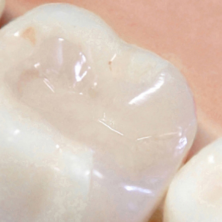 吉祥寺の虫歯の治療