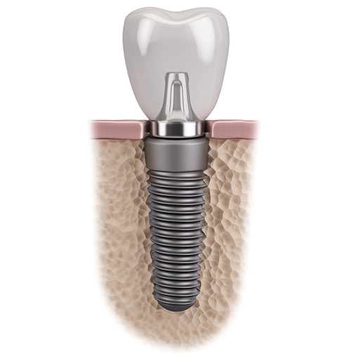 吉祥寺のインプラント治療