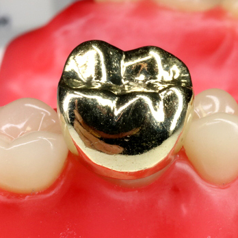 吉祥寺の審美歯科(白い詰め物・被せ物)