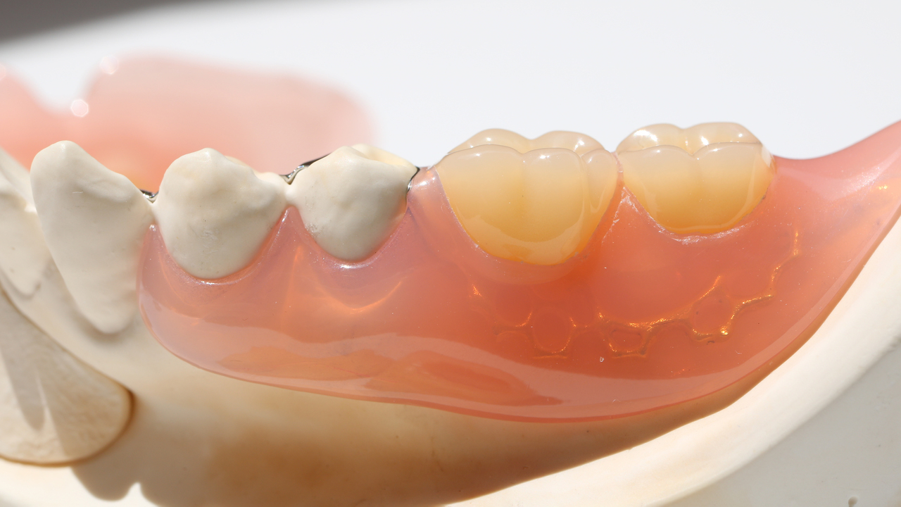 吉祥寺のノンクラスプデンチャー治療