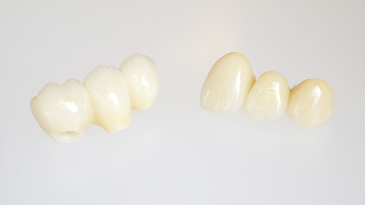 吉祥寺のエクストルージョン（歯根挺出術）