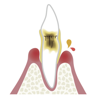 吉祥寺の歯周病の治療