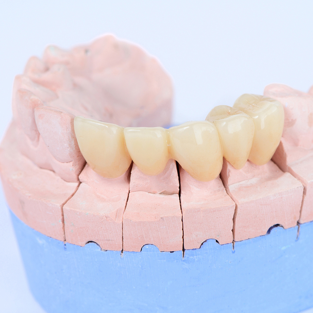 吉祥寺のセラミック治療