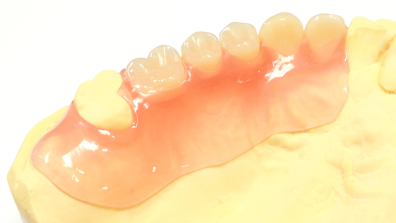 吉祥寺のノンクラスプデンチャー治療