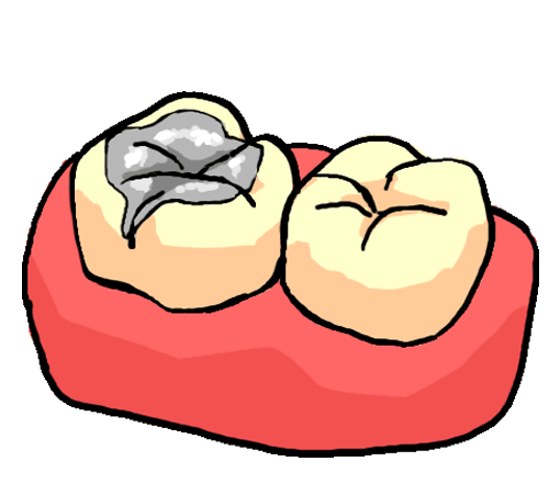 吉祥寺の危険なアマルガムの詰め物