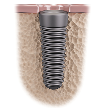 吉祥寺のインプラント治療