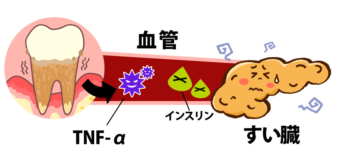 吉祥寺の50歳からの歯科治療｜糖尿病など生活習慣病の方へ